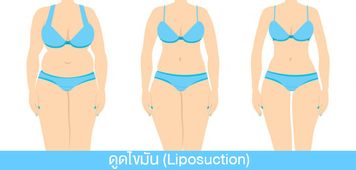 การดูดไขมัน Liposuction
